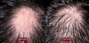 Cortisore Injection